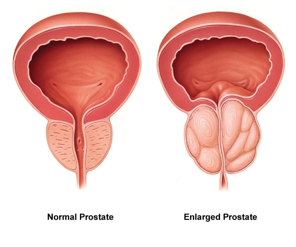 Los Cuidados de la Próstata: la Combinación Perfecta, Según los Urólogos Experimentados
